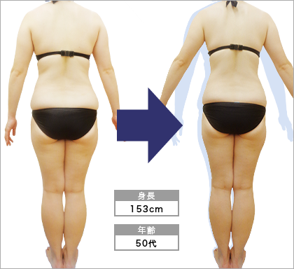 西院店T･H様の3ヶ月での痩身ビフォーアフター（後ろ）