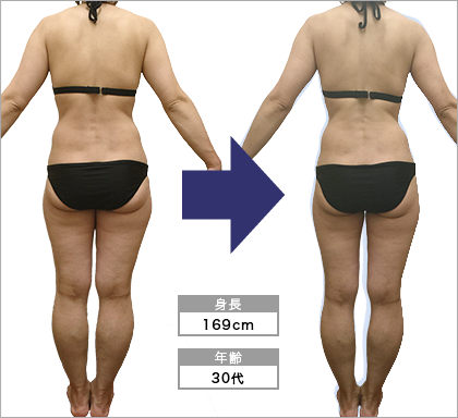 西院店K･S様の3ヶ月での痩身ビフォーアフター（後ろ）
