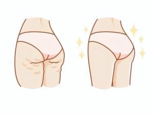 セルライトとは❓️