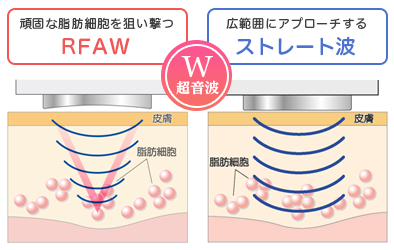 RFAW波ストレート波のダブル超音波