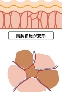 脂肪細胞が変形したイメージ