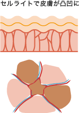 セルライトで皮膚が凸凹になるイメージ